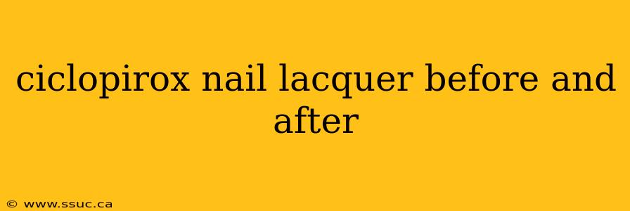 ciclopirox nail lacquer before and after